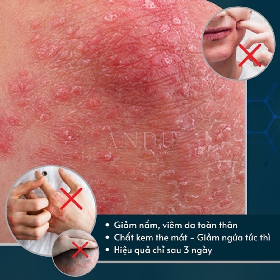 Kem Bôi Viêm Da Cơ Địa NHẬT BẢN Hết Lác Đồng Tiền, Hắc Lào, Ghẻ Nước, Á Sừng Cực Kì Hiệu Quả Kem Bôi Viêm Da Cơ Địa NHẬT BẢN Hết Lác Đồng Tiền, Hắc Lào, Ghẻ Nước, Á Sừng Cực Kì Hiệu Quả