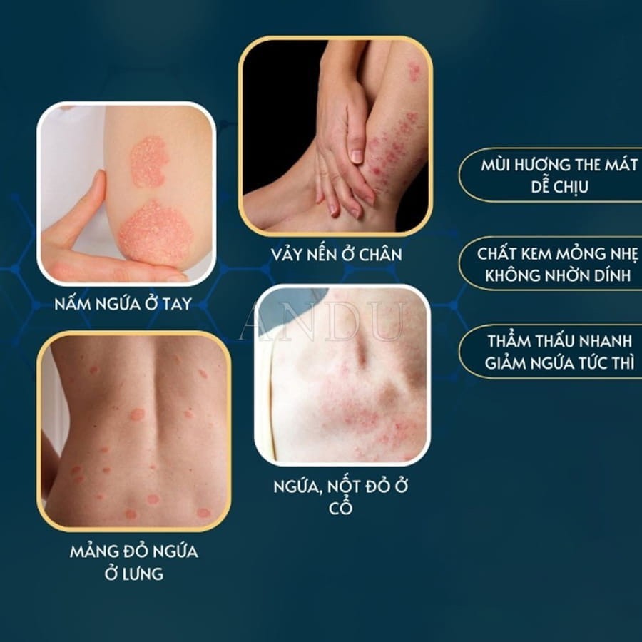 Kem Bôi Viêm Da Cơ Địa NHẬT BẢN Hết Lác Đồng Tiền, Hắc Lào, Ghẻ Nước, Á Sừng Cực Kì Hiệu Quả Kem Bôi Viêm Da Cơ Địa NHẬT BẢN Hết Lác Đồng Tiền, Hắc Lào, Ghẻ Nước, Á Sừng Cực Kì Hiệu Quả