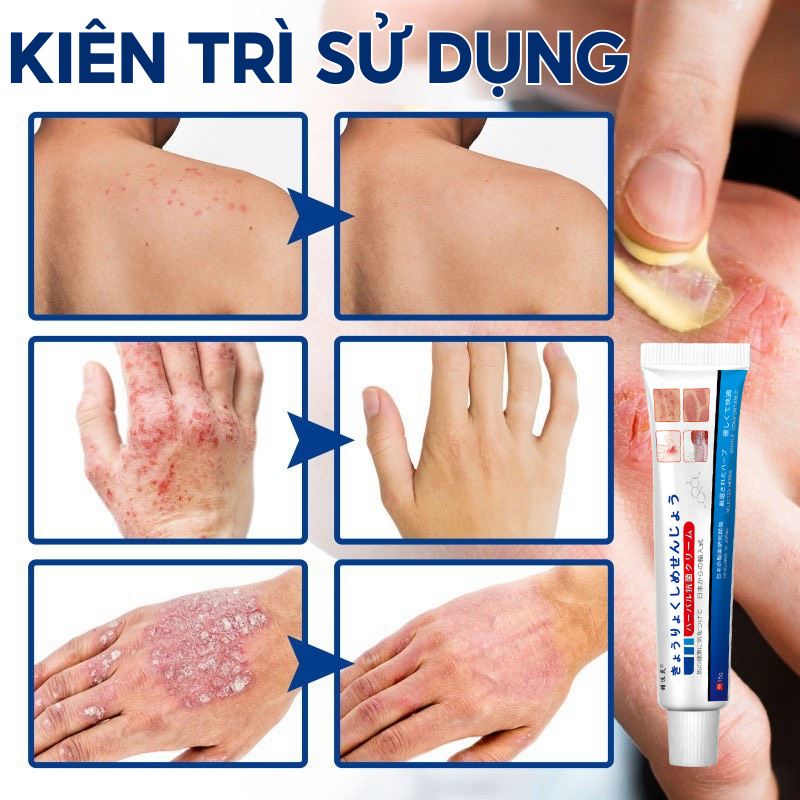 Kem Bôi Viêm Da Cơ Địa NHẬT BẢN Hết Lác Đồng Tiền, Hắc Lào, Ghẻ Nước, Á Sừng Cực Kì Hiệu Quả Kem Bôi Viêm Da Cơ Địa NHẬT BẢN Hết Lác Đồng Tiền, Hắc Lào, Ghẻ Nước, Á Sừng Cực Kì Hiệu Quả