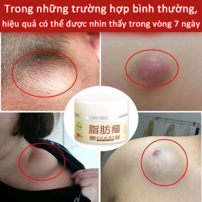 Kem nóng chảy mỡ thừa cho khối u tuyến giáp và mỡ dưới da, hỗ trợ làm tan mỡ cục bộ